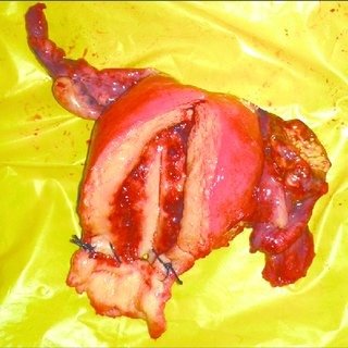 Hysterectomy-specimen-showing-granuloma-in-right-tube_Q320.jpg