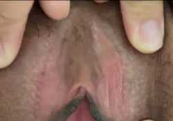 斯基恩氏腺這樣有沒有怪怪的